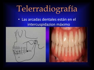 Telerradiografía
• Las arcadas dentales están en el
intercuspidazion máximo
 