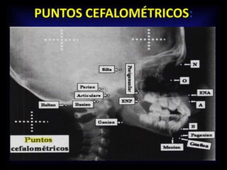 PUNTOS CEFALOMÉTRICOS:
 