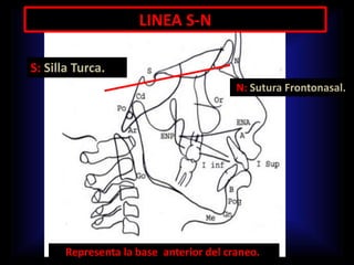 LINEA S-N
Representa la base anterior del craneo.
S: Silla Turca.
N: Sutura Frontonasal.
 