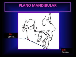 PLANO MANDIBULAR
Go:
Gonion
Gn:
Gnation
 