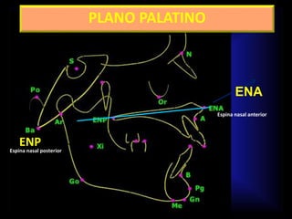 PLANO PALATINO
ENP
ENA
Espina nasal posterior
Espina nasal anterior
 