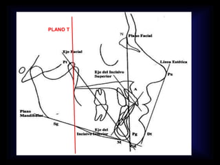 PLANO T
 