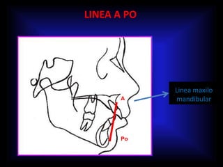 LINEA A PO
Linea maxilo
mandibularA
Po
 