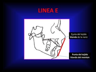 LINEA E
Punta del tejido
blando de la nariz
Punta del tejido
blando del menton
 
