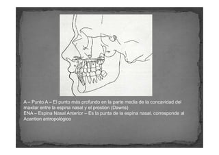 A – Punto A – El punto más profundo en la parte media de la concavidad del
maxilar entre la espina nasal y el prostion (Da...