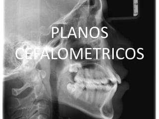 PLANOS
CEFALOMETRICOS

 