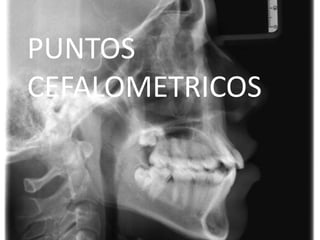 PUNTOS
CEFALOMETRICOS

 