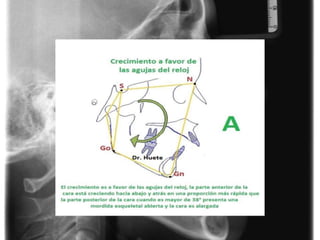 CEFALOMETRIA    Dr. Huete