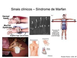 Sinais clínicos – Síndrome de Marfan
Rinaldo Pereira - UCB - DF
 