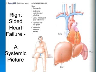 16
Right
Sided
Heart
Failure -
A
Systemic
Picture
 