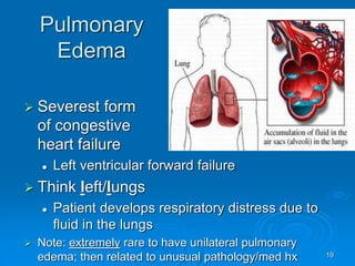 19
Pulmonary
Edema
 Severest form
of congestive
heart failure
 Left ventricular forward failure
 Think left/lungs
 Patient develops respiratory distress due to
fluid in the lungs
 Note: extremely rare to have unilateral pulmonary
edema; then related to unusual pathology/med hx
 
