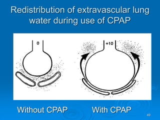 49
Redistribution of extravascular lung
water during use of CPAP
Without CPAP With CPAP
 