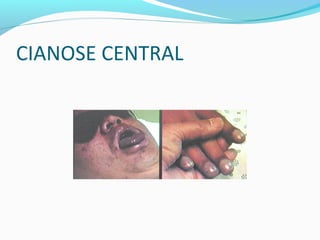 CIANOSE CENTRAL
 