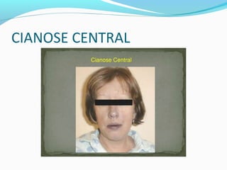 CIANOSE CENTRAL
 