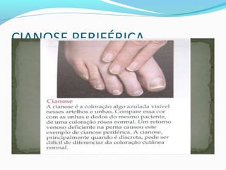CIANOSE PERIFÉRICA
 