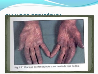 CIANOSE PERIFÉRICA
 