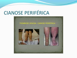 CIANOSE PERIFÉRICA
 