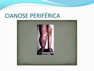 CIANOSE PERIFÉRICA
 