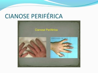 CIANOSE PERIFÉRICA
 