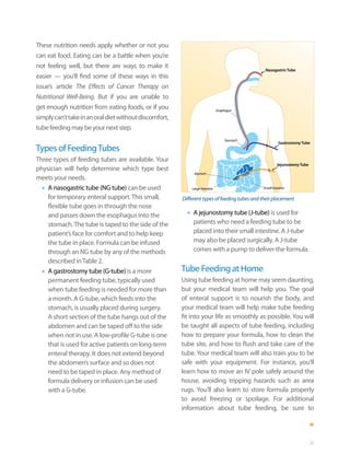 These nutrition needs apply whether or not you
can eat food. Eating can be a battle when you’re
not feeling well, but there are ways to make it
                                                                                              Nasogastric Tube
easier — you’ll find some of these ways in this
issue’s article The Effects of Cancer Therapy on
Nutritional Well-Being. But if you are unable to
get enough nutrition from eating foods, or if you                             Esophagus

simply can’t take in an oral diet without discomfort,
tube feeding may be your next step.
                                                                                  Stomach
                                                                                                       Gastrostomy Tube
Types of Feeding Tubes
Three types of feeding tubes are available. Your
                                                                                                      Jejunostomy Tube
physician will help determine which type best
                                                             Jejunum
meets your needs.
  •	A nasogastric tube (NG tube) can be used                Large intestine                  Small intestine

    for temporary enteral support. This small,          Different types of feeding tubes and their placement
    flexible tube goes in through the nose
    and passes down the esophagus into the                •	 A jejunostomy tube (J-tube) is used for
    stomach. The tube is taped to the side of the            patients who need a feeding tube to be
    patient’s face for comfort and to help keep              placed into their small intestine. A J-tube
    the tube in place. Formula can be infused                may also be placed surgically. A J-tube
    through an NG tube by any of the methods                 comes with a pump to deliver the formula.
    described in Table 2.
  •	A gastrostomy tube (G-tube) is a more               Tube Feeding at Home
    permanent feeding tube, typically used              Using tube feeding at home may seem daunting,
    when tube feeding is needed for more than           but your medical team will help you. The goal
    a month. A G-tube, which feeds into the             of enteral support is to nourish the body, and
    stomach, is usually placed during surgery.          your medical team will help make tube feeding
    A short section of the tube hangs out of the        fit into your life as smoothly as possible. You will
    abdomen and can be taped off to the side            be taught all aspects of tube feeding, including
    when not in use. A low-profile G-tube is one        how to prepare your formula, how to clean the
    that is used for active patients on long-term       tube site, and how to flush and take care of the
    enteral therapy. It does not extend beyond          tube. Your medical team will also train you to be
    the abdomen’s surface and so does not               safe with your equipment. For instance, you’ll
    need to be taped in place. Any method of            learn how to move an IV pole safely around the
    formula delivery or infusion can be used            house, avoiding tripping hazards such as area
    with a G-tube.                                      rugs. You’ll also learn to store formula properly
                                                        to avoid freezing or spoilage. For additional
                                                        information about tube feeding, be sure to



                                                                                                                         27
 