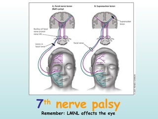 7th
nerve palsy
Remember: LMNL affects the eye
 