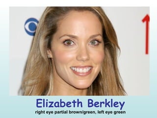 Elizabeth Berkley
right eye partial brown/green, left eye green
 