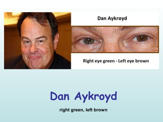 Dan Aykroyd
right green, left brown
 