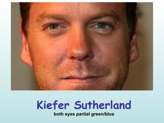 Kiefer Sutherland
both eyes partial green/blue
 