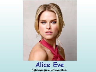 Alice Eve
right eye grey, left eye blue.
 