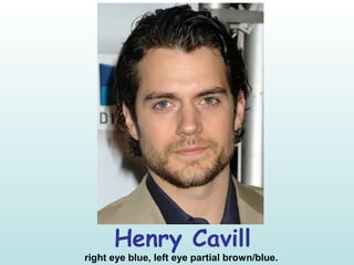 Henry Cavill
right eye blue, left eye partial brown/blue.
 