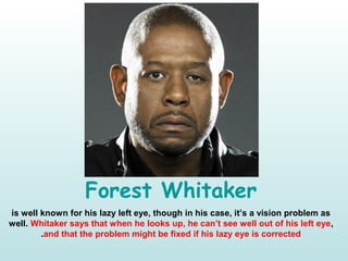 Forest Whitaker
is well known for his lazy left eye, though in his case, it’s a vision problem as
well. Whitaker says that when he looks up, he can’t see well out of his left eye,
and that the problem might be fixed if his lazy eye is corrected.
 
