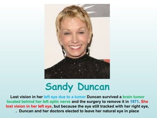 Sandy Duncan
Lost vision in her left eye due to a tumor Duncan survived a brain tumor
located behind her left optic nerve and the surgery to remove it in 1971. She
lost vision in her left eye, but because the eye still tracked with her right eye,
Duncan and her doctors elected to leave her natural eye in place.
 