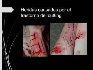 Heridas causadas por el
trastorno del cutting
 