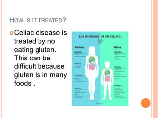 HOW IS IT TREATED?
Celiac disease is
treated by no
eating gluten.
This can be
difficult because
gluten is in many
foods .
 