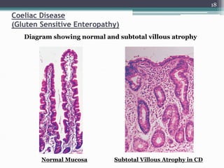 celiac disease 0r gluten enteropathy ppty | PPT