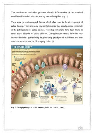 4
This autoimmune activation produces chronic inflammation of the proximal
small bowel intestinal mucosa, leading to malabsorption. (Fig. 2)
There may be environmental factors which play roles in the development of
celiac disease. There are some studies that indicate that infection may contribute
in the pathogenesis of celiac disease. Rod-shaped bacteria have been found in
small bowel biopsies of celiac children. Campylobacter enteric infection may
increase intestinal permeability in genetically predisposed individuals and thus
may increase the chance of developing celiac [4]
Fig. 2: Pathophysiology of celiac disease (Sollid and Lundin., 2009).
.
 