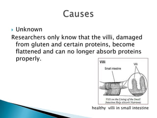 UnknownResearchers only know that the villi, damaged from gluten and certain proteins, become flattened and can no longer absorb proteins properly.Causeshealthy  villi in small intestine