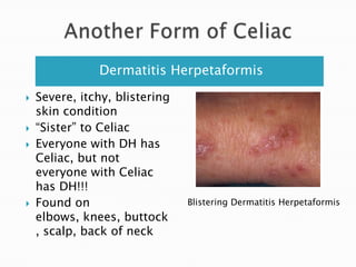 Serological (blood) TestsStudy of the blood stream where doctors look for antibodies that are forming in response to an infection to one’s own proteins. BiopsyIf a serological test comes back positive, a biopsy of the villi in the small intestine is completed.You can also biopsy the dermatitis Herpetaformisif you have that form of CeliacEnforced Gluten-Free dietIf the blood test and biopsy come back positive, the patient is put on GF diet, if he/she responds positively to the diet and the villi in the small intestine returns to normal, the patient is unfortunately diagnosed with Celiac Disease. Diagnosis Process