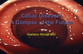 Celiac Disease:
A Glimpse of the Future

      Gaetano Morelli MD




                           1
 