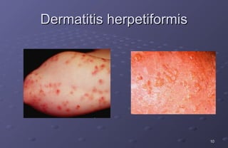 Dermatitis herpetiformis




                           10
 