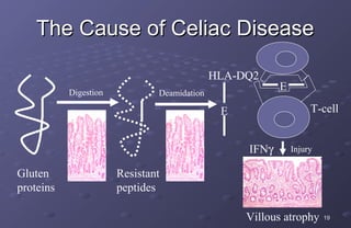 The Cause of Celiac Disease

                                             HLA-DQ2
           Digestion           Deamidation
                                                         E

                                              E                   T-cell


                                                  IFNγ       Injury

Gluten                 Resistant
proteins               peptides

                                                  Villous atrophy     19
 