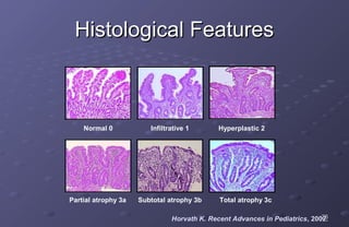 Histological Features



    Normal 0            Infiltrative 1       Hyperplastic 2




Partial atrophy 3a   Subtotal atrophy 3b     Total atrophy 3c

                                                                            26
                               Horvath K. Recent Advances in Pediatrics, 2002.
 