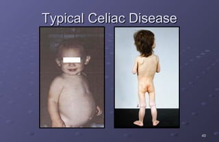 Typical Celiac Disease




                         40
 