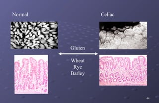 Normal            Celiac




         Gluten

         Wheat
          Rye
         Barley



                           44
 