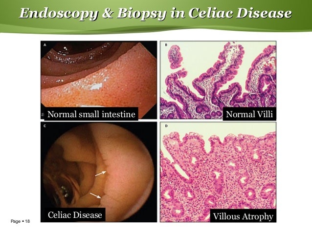 celiac endoscopy findings celiac endoscopy findings