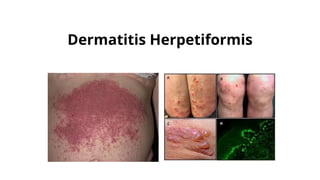 Dermatitis Herpetiformis
 