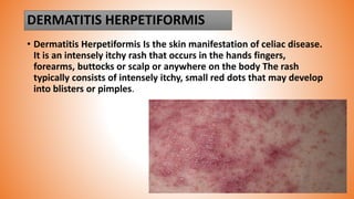 DERMATITIS HERPETIFORMIS
• Dermatitis Herpetiformis Is the skin manifestation of celiac disease.
It is an intensely itchy rash that occurs in the hands fingers,
forearms, buttocks or scalp or anywhere on the body The rash
typically consists of intensely itchy, small red dots that may develop
into blisters or pimples.
 