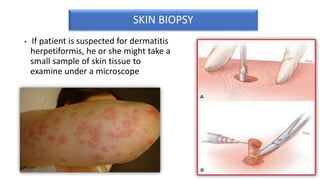 SKIN BIOPSY
• If patient is suspected for dermatitis
herpetiformis, he or she might take a
small sample of skin tissue to
examine under a microscope
 