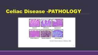 Celiac Disease -PATHOLOGY
 