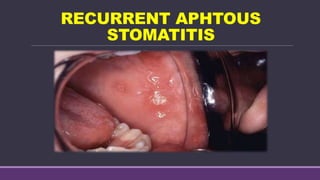 RECURRENT APHTOUS
STOMATITIS
 